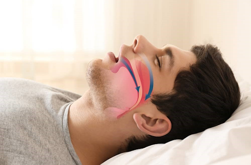How Snoring Surgery Can Improve Your Sleep Quality and Health