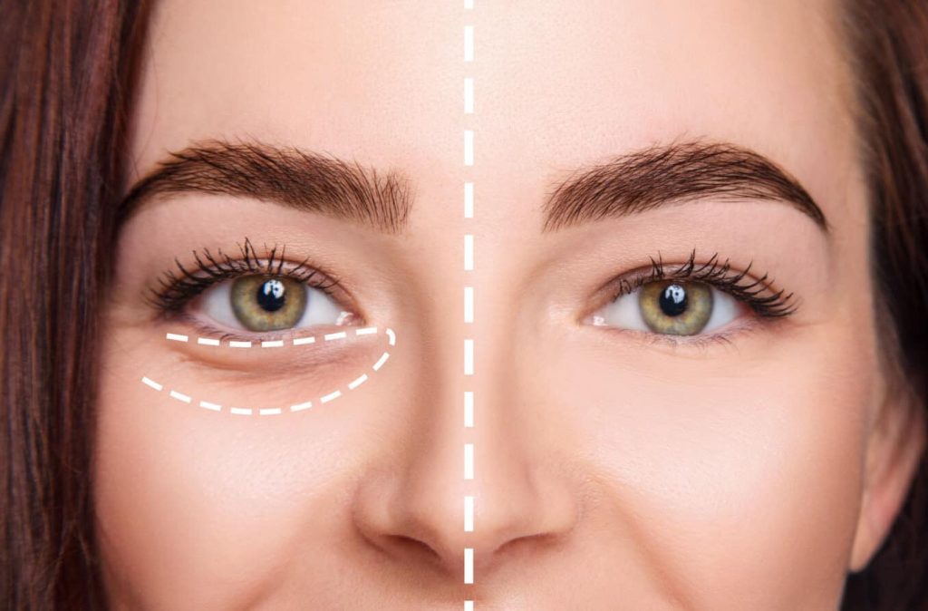 Laser Treatment for Dark Circles: A Modern Solution for Brighter, Youthful Eyes